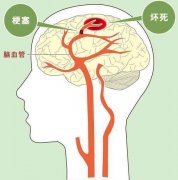 腦(nǎo)梗塞的(de)康複治療方法